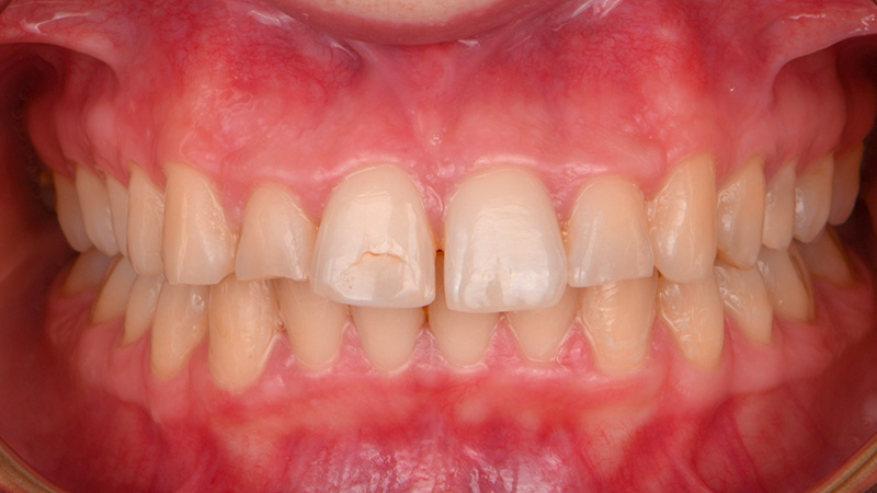 aligneurs et restauration antérieure, face ferme