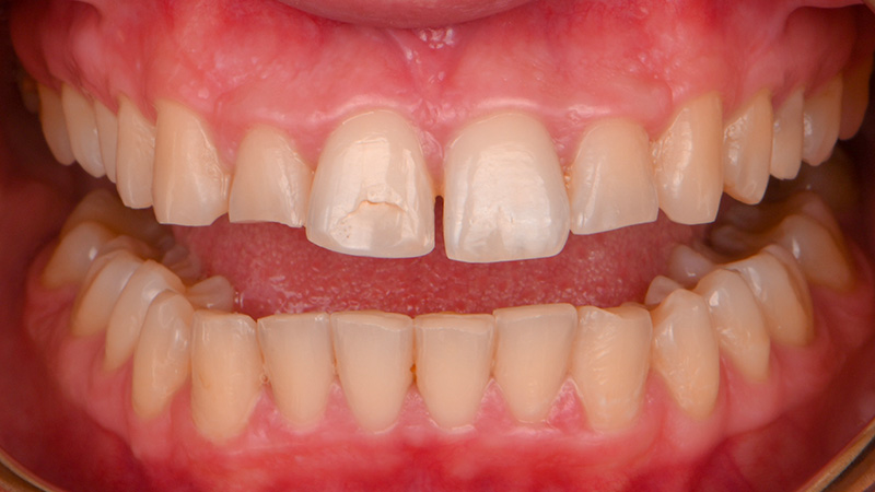 aligneurs et restauration antérieure, face ouverte