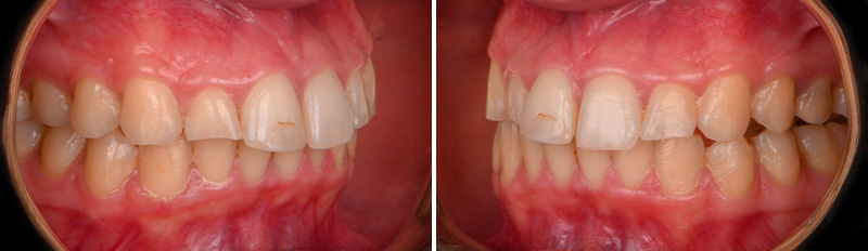 restauration antérieure, face ferme