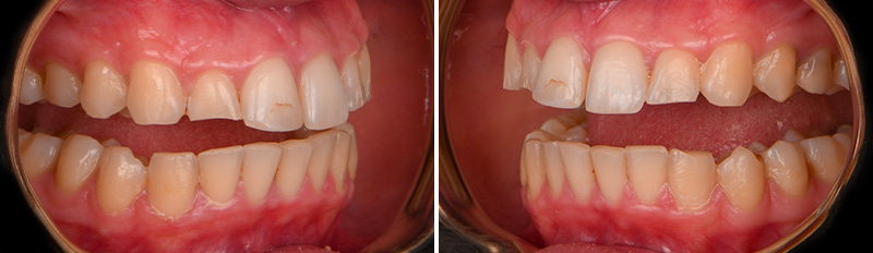 Restauration antérieure, face ouverte