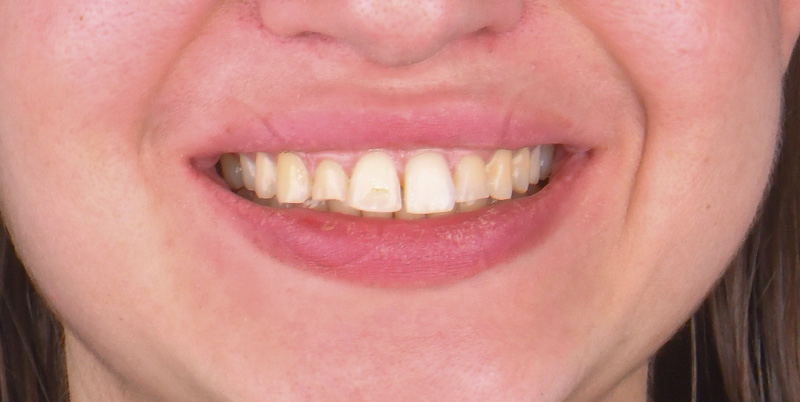 Cas patiente, sourire avant