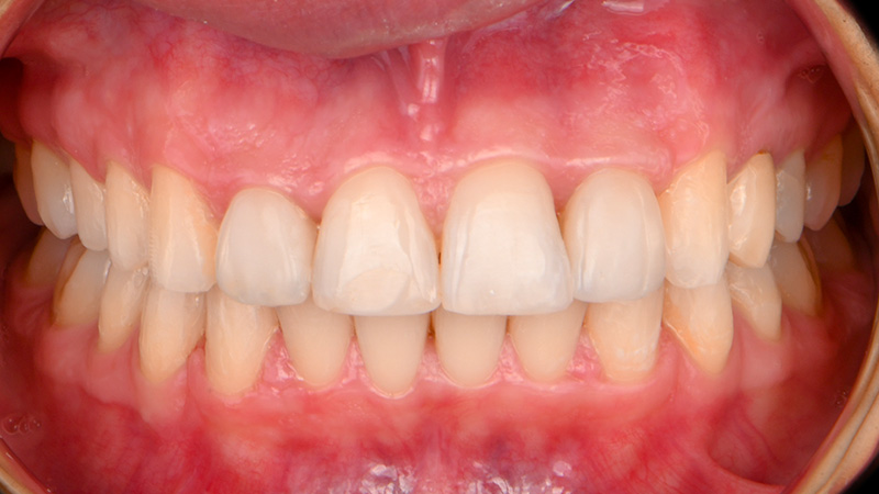 aligneurs et restauration postérieure, face ferme