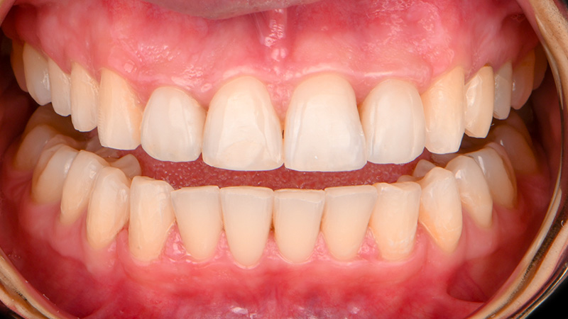 aligneurs et restauration postérieure, face ouvert