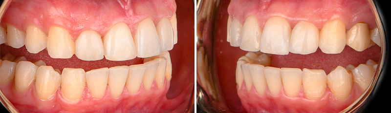 Restauration postérieure, côté ouvert