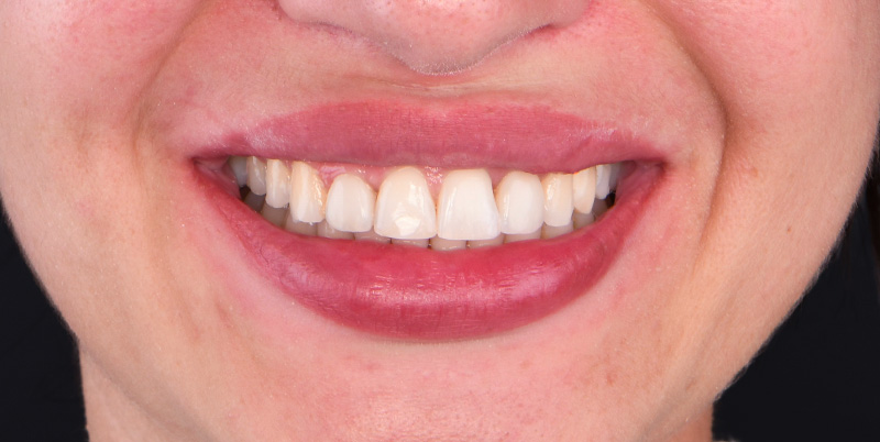 sourire postérieure, patiente