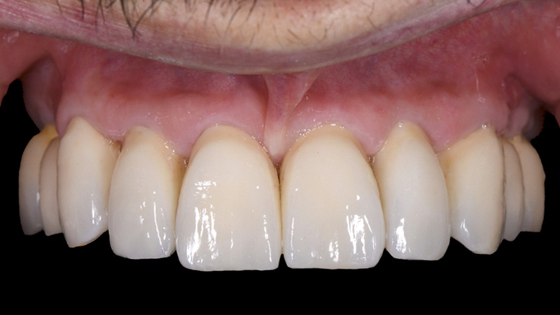FujiCEM Evolve - Cicatrisation des tissus mous 2 semaines après le scellement : vue frontale des couronnes unitaires en zircone cubique