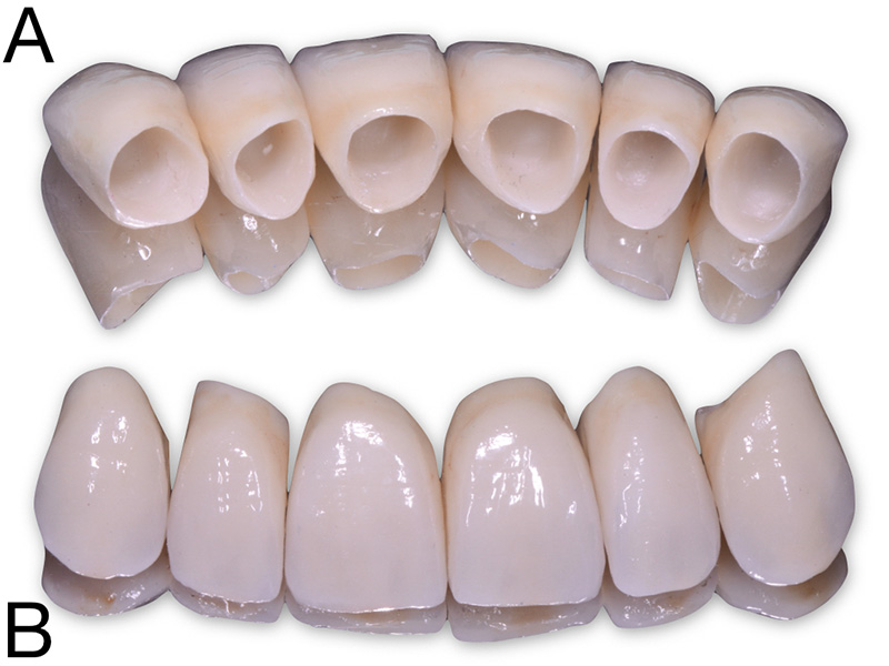 FujiCEM Evolve - Couronnes unitaires antérieures en zircone cubique stratifiée. a : vue de l’intrados; b : vue vestibulaire.