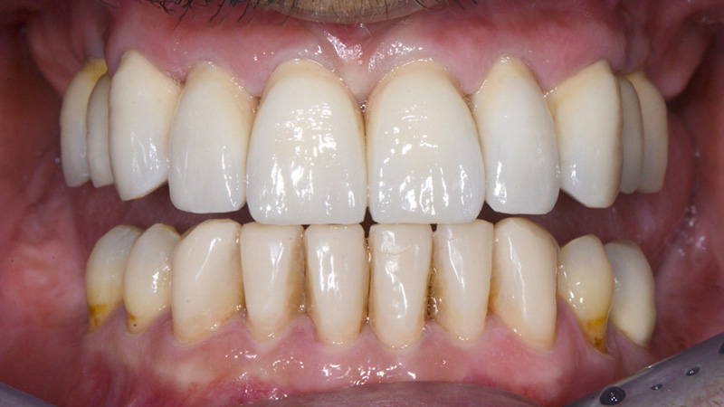 Vue postopératoire : couronnes unitaires en zircone cubique stratifiée dans l’arcade maxillaire et restaurations en composites injectés en technique directe dans l’arcade mandibulaire.