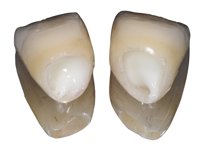 Couronnes en zircone pour les incisives centrales supérieures remplies de ciment verre ionomère modifié par adjonction de résine