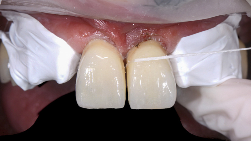 Élimination de l’excès de ciment interproximal des incisives centrales