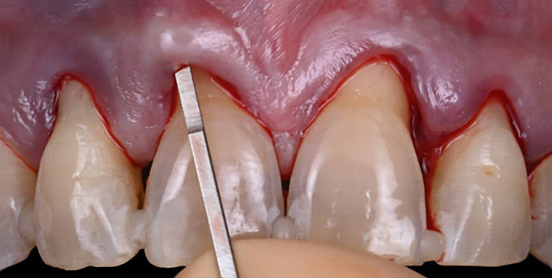 Visibilité de lame spoonblade® en transparence dans le lambeau 