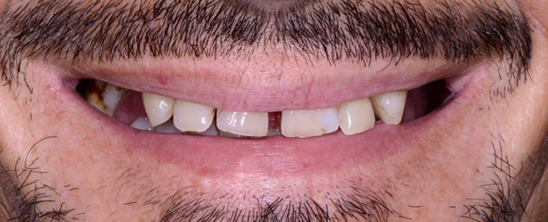 FujiCEM Evolvet, Vue extra-orale préopératoire