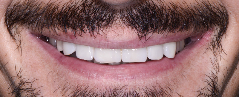 Vue extra-orale postopératoire