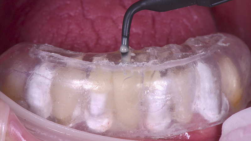 Restauration des dents antérieures inférieures par la technique d’injection de composite