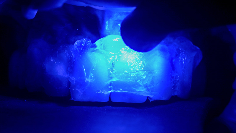 Photopolymérisation des limites marginales prothétiques des couronnes en zircone au travers d’une barrière à l’oxygène