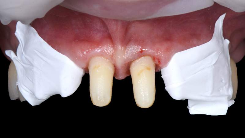 Scellement des incisives centrales supérieures avec protection en PTFE