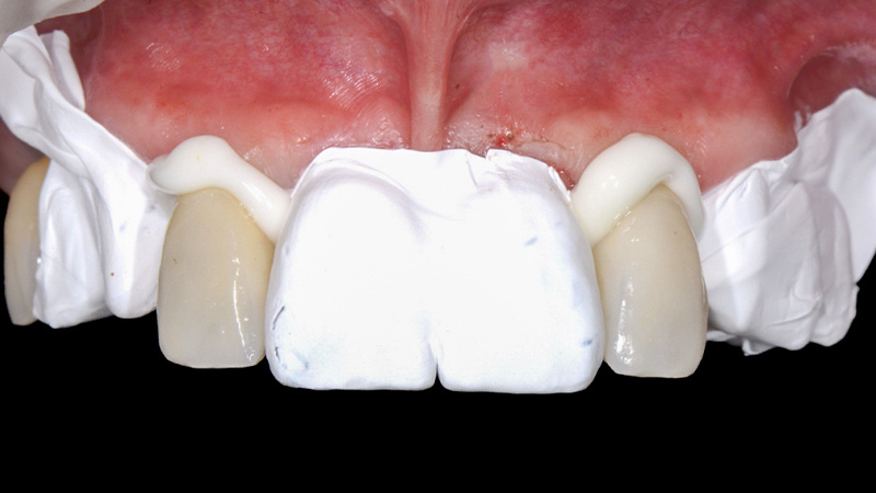 Scellement des incisives latérales supérieures avec protection en PTFE