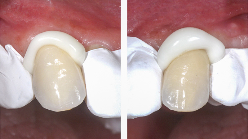 Scellement des canines supérieures avec protection en PTFE