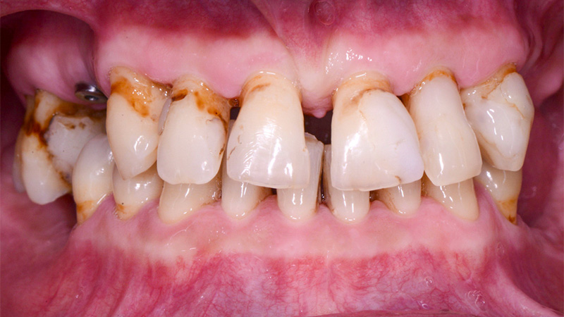 FujiCEM Evolvet, FujiCEM Evolvet