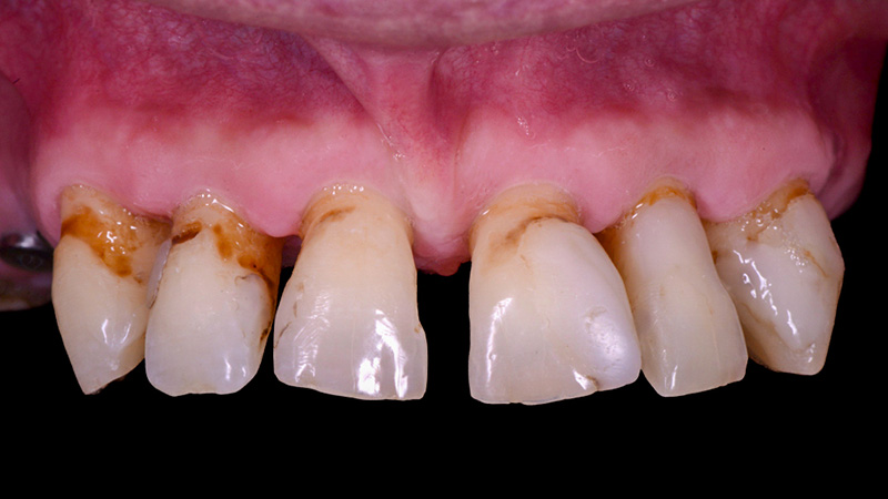 Vue préopératoire détaillée des dents antérieures supérieures.