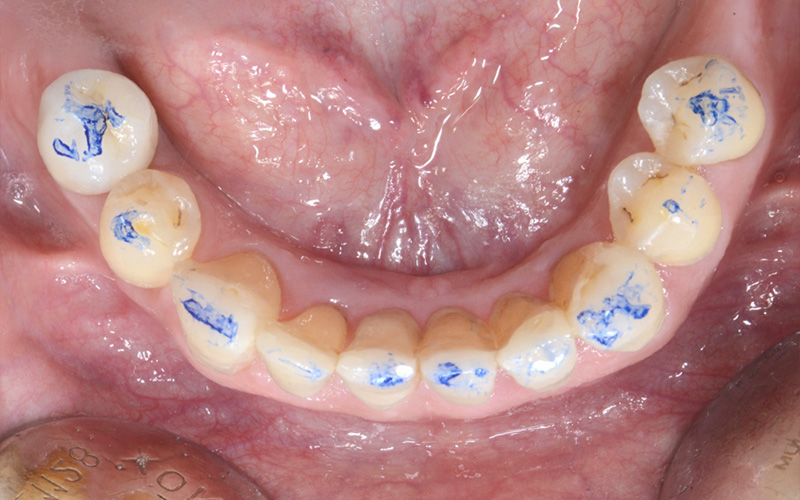 Vérification fonctionnelle de l’occlusion au niveau de l’arcade mandibulaire