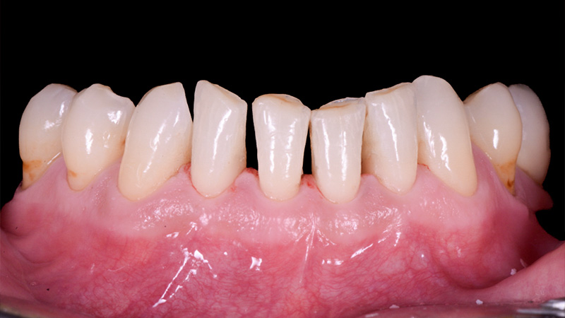 Vue préopératoire des dents antérieures inférieures