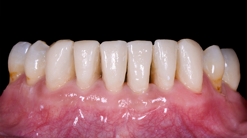 Vue postopératoire des dents inférieures restaurées par des composites injectés en technique directe.