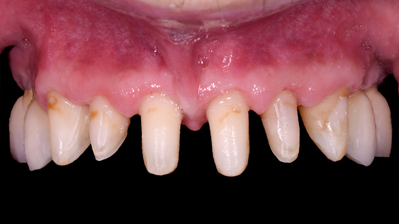 FujiCEM Evolve - Préparations des dents antérieures supérieures pour la pose des couronnes unitaires.