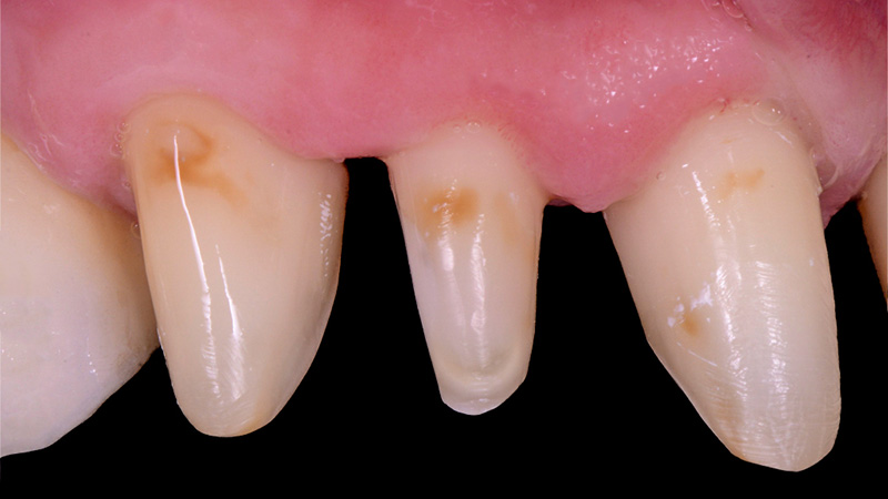 Vue détaillée du côté droit des préparations dentaires.