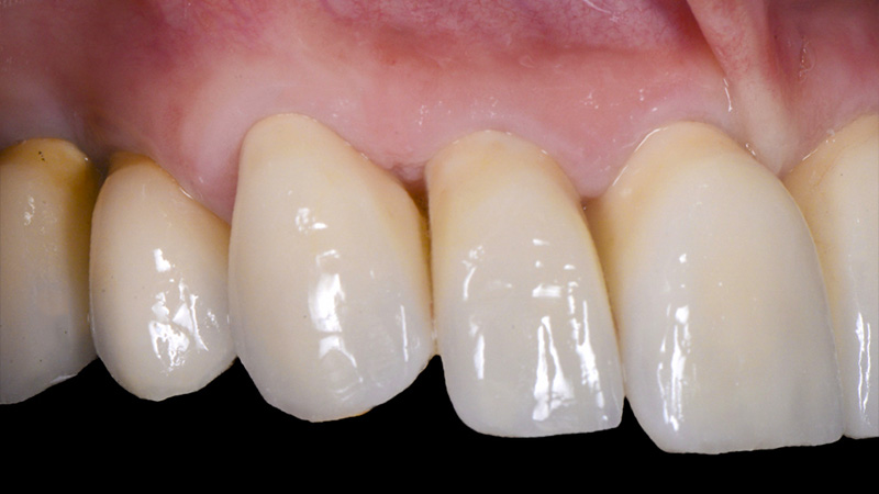 Vue détaillée postopératoire du côté droit des couronnes unitaires en zircone cubique.