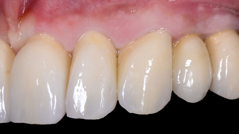 Vue détaillée postopératoire du côté gauche des couronnes unitaires en zircone cubique.