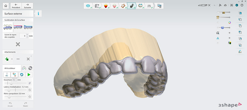 Eclaircissement dentaire, conception de la gouttière d’éclaircissement 