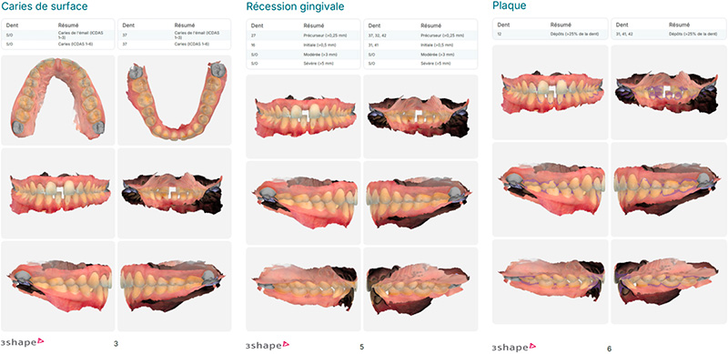 Eclaircissement dentaire, rapport diagnostique 