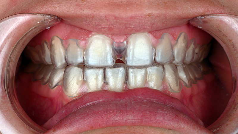 Essayage des gouttières