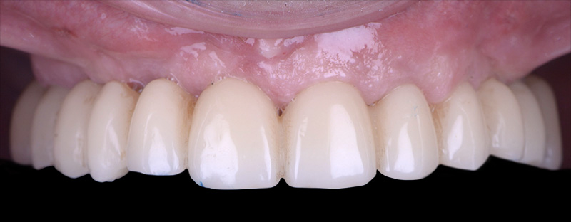 implantologie, situation à un mois postopératoire