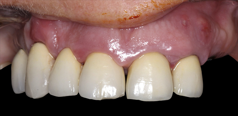 implantologie, situation initiale