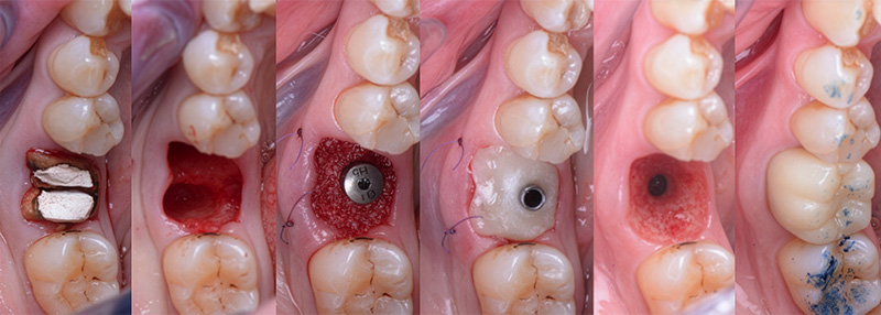 Phases chirurgicales et prothétiques de la réalisation de l’EII postérieure et du SSA