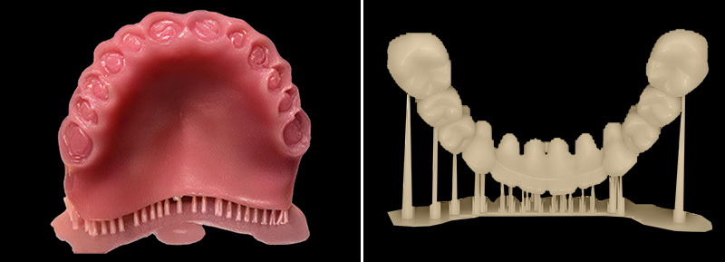 prothèses amovibles complètes imprimées
